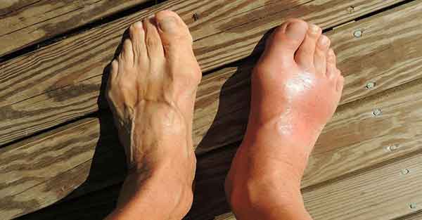 Reduce Swelling In The Feet